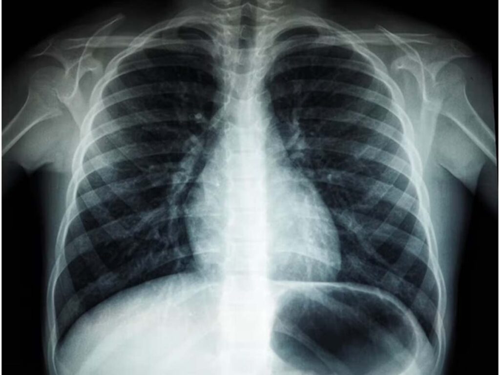 Why Do You Need Chest X-Ray for Immigration